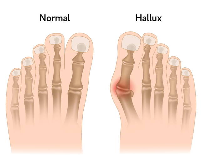 hallux-fuss.jpg